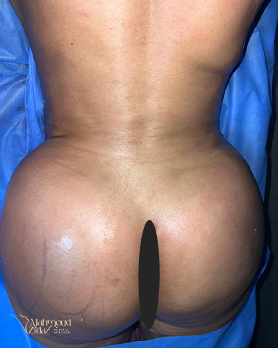 بعد العملية 1