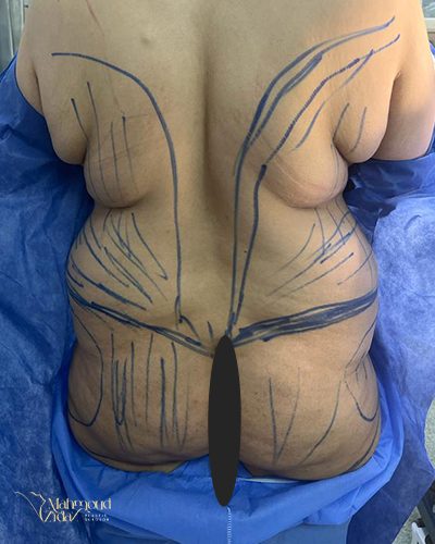 قبل العملية 1