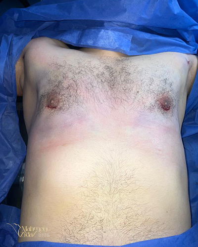 بعد العملية 1