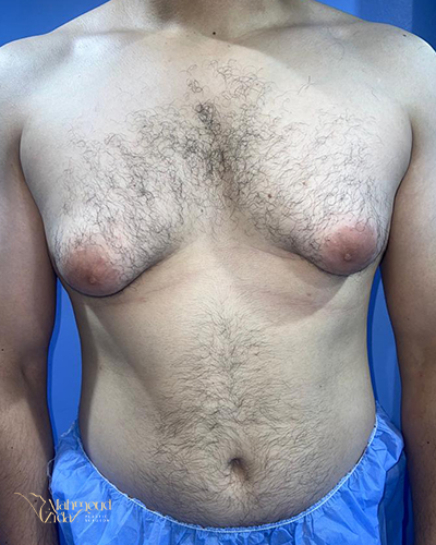 قبل العملية 1