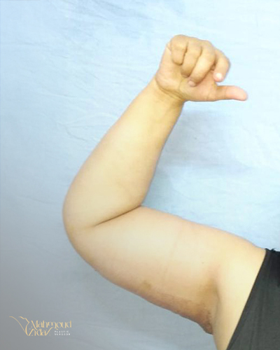 بعد العملية 1