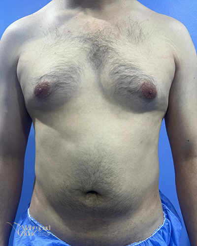 قبل العملية 1