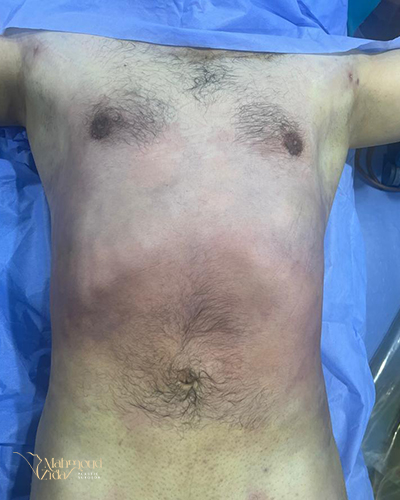 بعد العملية 1