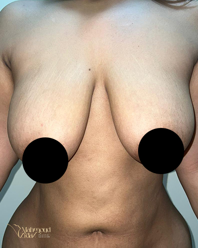 قبل العملية 1