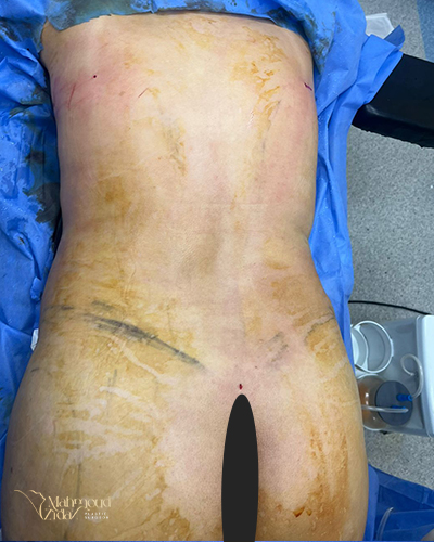 قبل العملية 1