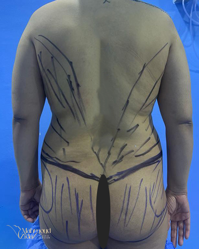 قبل العملية 1