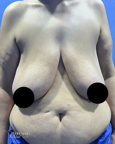 قبل العملية 1